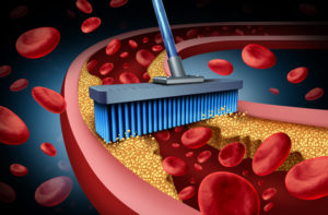 Chelation Medicine Treatment. Broom cleaning out blocked artery.