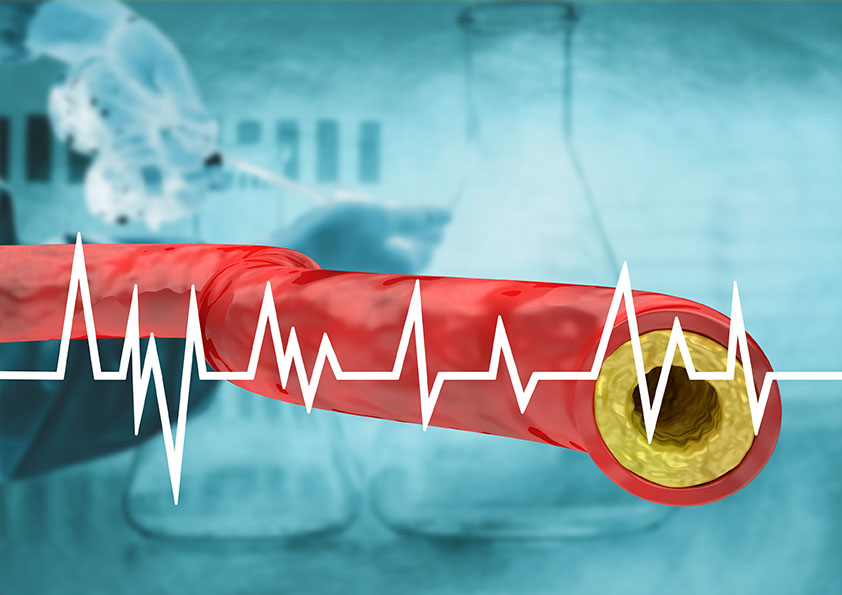 cholesterol and heart disease